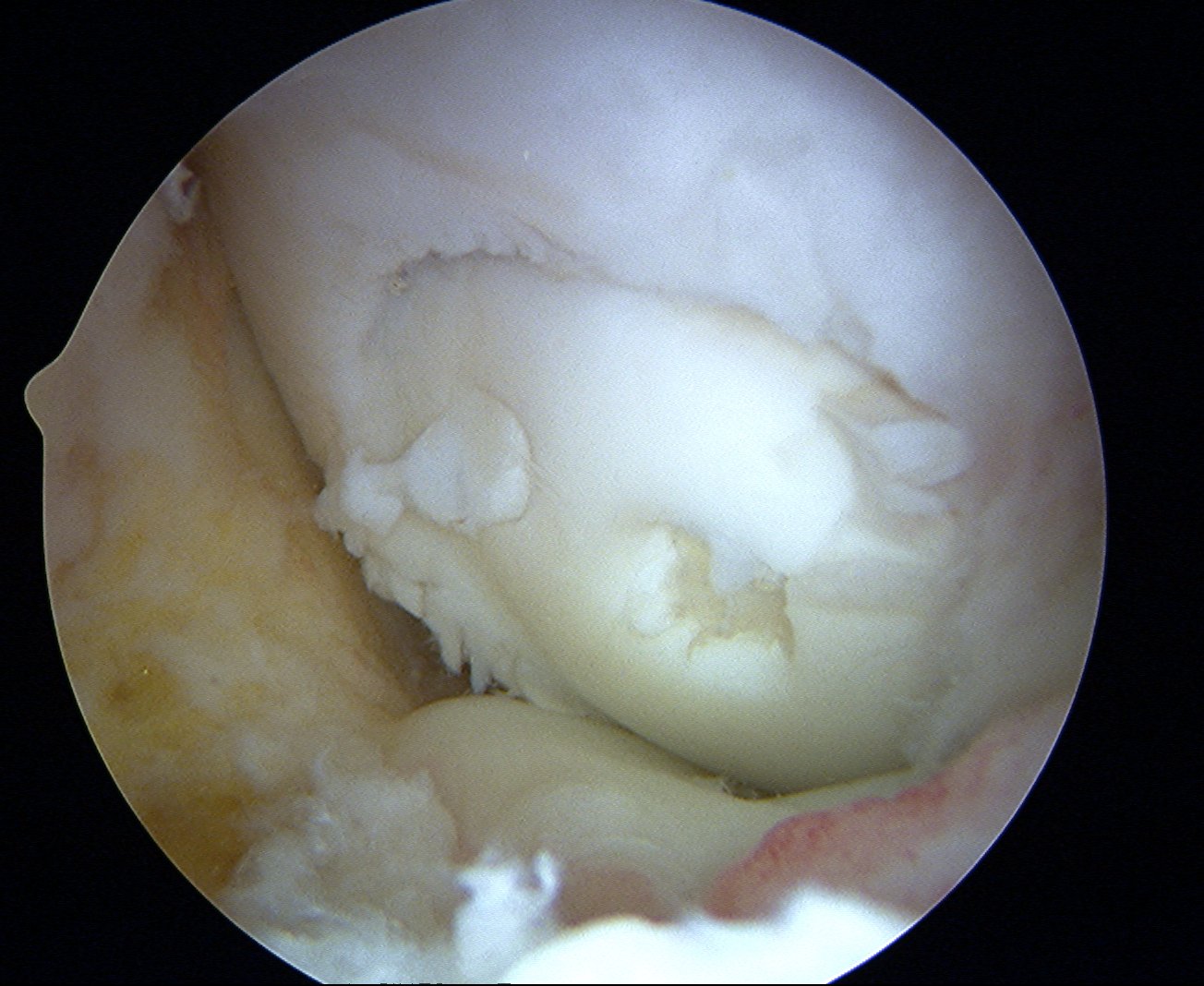 Mosaicplasty Plugs in OCD